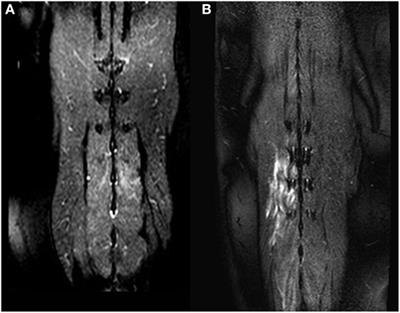 Magnetic Resonance Imaging Signal Alterations in Paraspinal Muscles in Dogs with Acute Thoracolumbar Intervertebral Disk Extrusion